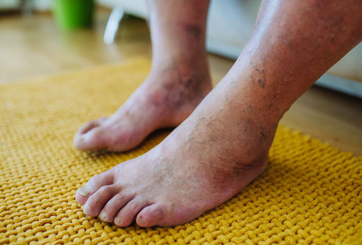 Feet with visible skin changes and discolouration, illustrating symptoms of peripheral neuropathy and foot numbness