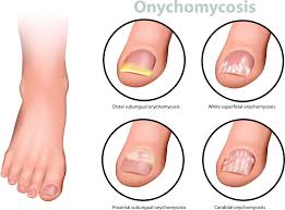 Diagram showing types of onychomycosis toenail fungus for podiatrist treatment