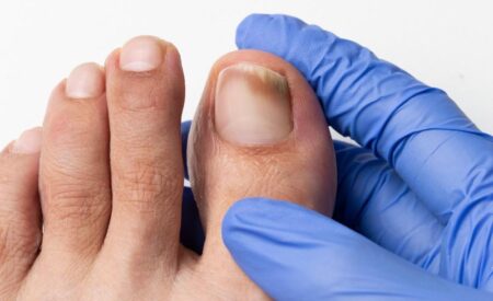 Toenail fungus treatment podiatrist examining toenail with fungal infection