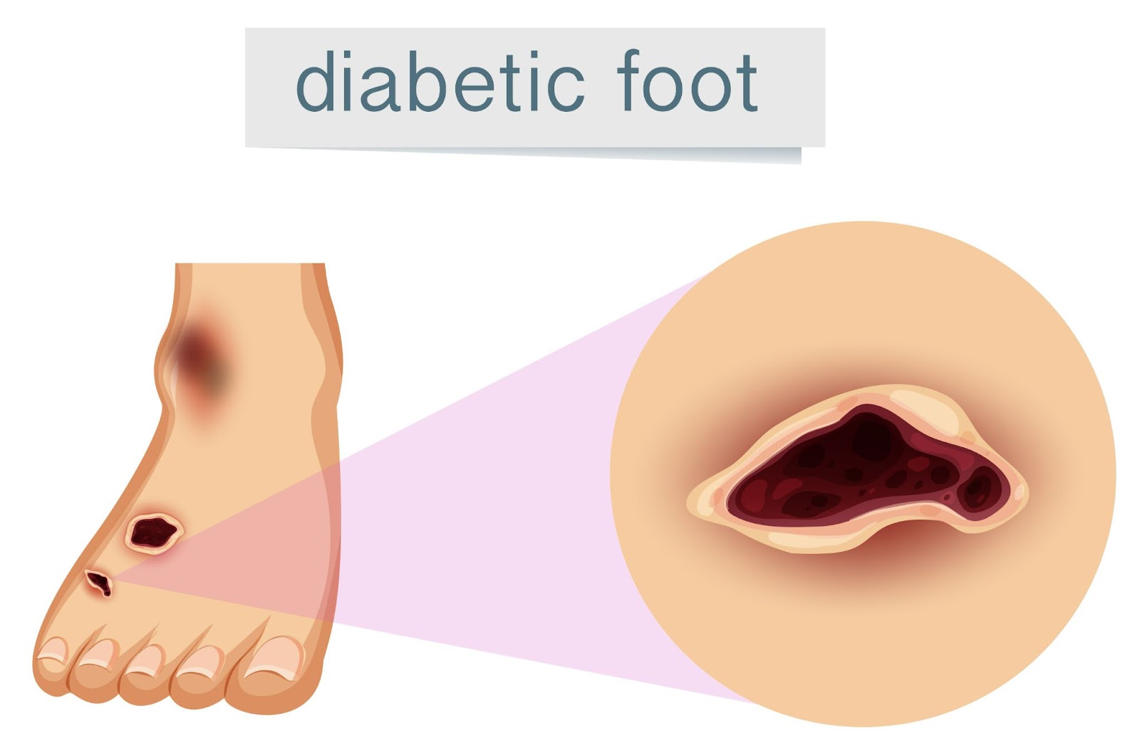 Close-up illustration of diabetic foot ulcer showing diabetic foot complications