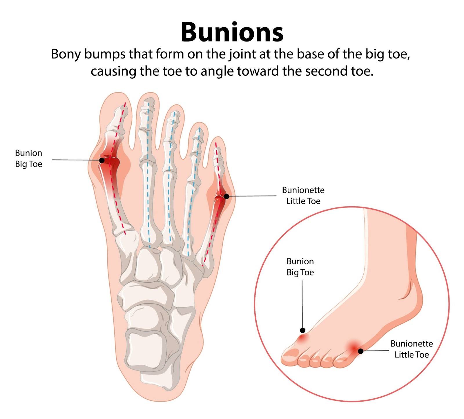 A diagram showing bunions treatment areas on big toe and little toe