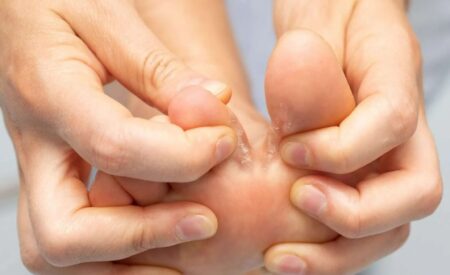 Athlete’s foot treatment in Sydney showing cracked skin between toes